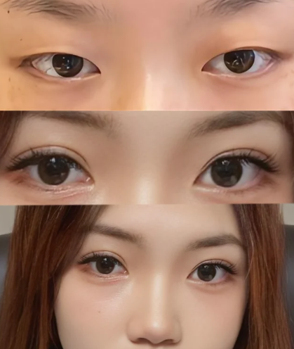 2026年成都双眼皮做得最好的是哪个医生？傅荣、练才华、卢尚兵？