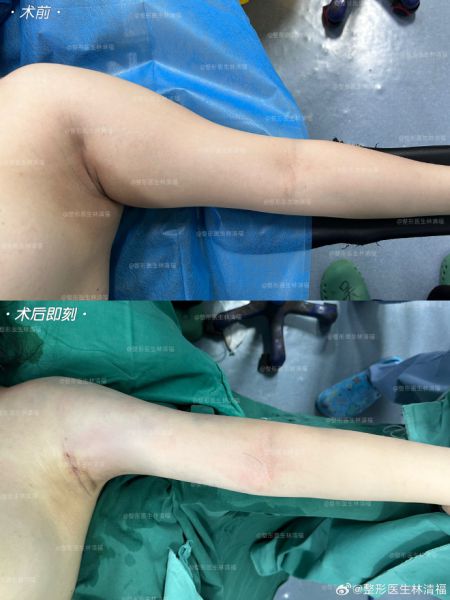 厦门做脂肪专家林清福和王阳明哪个医生吸脂好？