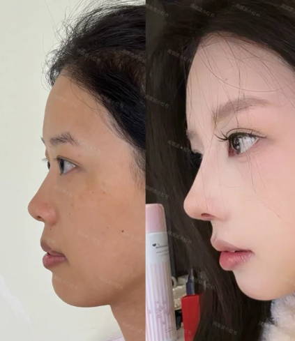 成都周顺波和李竞鼻修复哪个好?周顺波和李竞做隆鼻修复口碑谁更厉害?