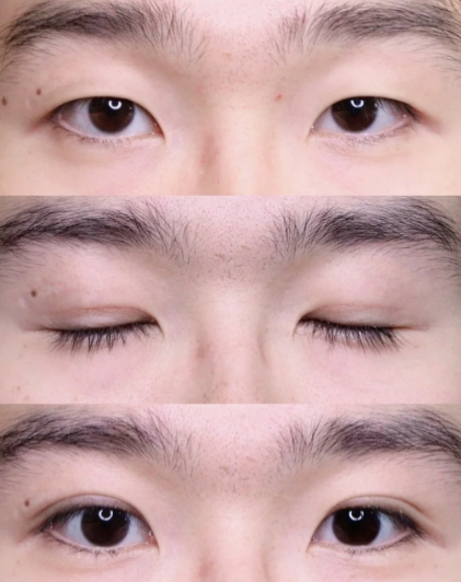 成都练才华和傅荣割双眼皮哪个好?练才华和傅荣双眼皮技术谁更好?