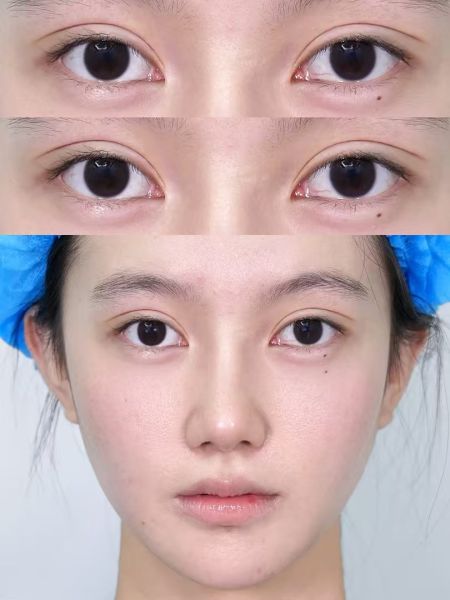 上海双眼皮医生哪个比较好?罗施、刘宇银、张蕾蕾、常梦玲、李欣豫、管果