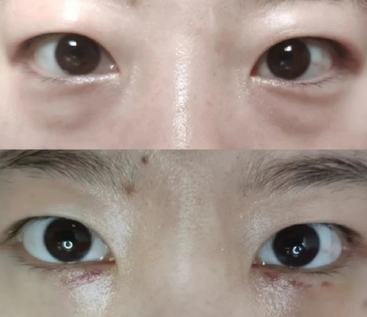 北京卜虹森和于燕祛眼袋这两个医生哪个最好？卜虹森和于燕祛眼袋预约咨询