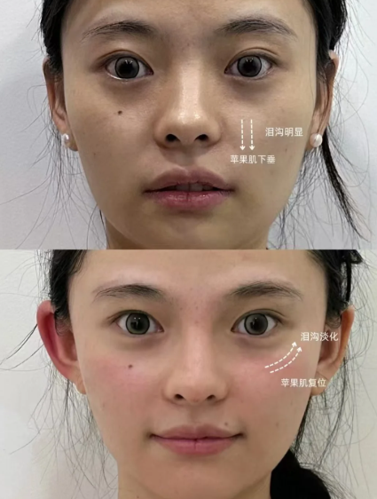 成都张艳锋苹果肌复位技术怎么样?张艳锋苹果机复位效果好吗?收费贵不贵?