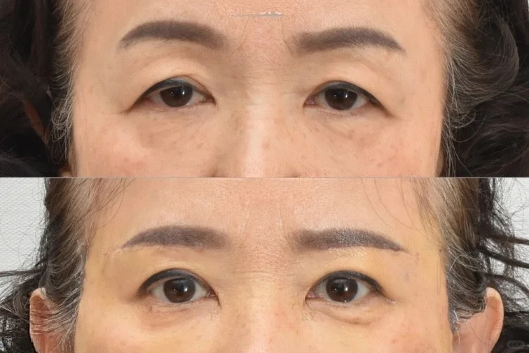 北京陈圣英和梁伟中哪个医生眼周抗衰效果好?