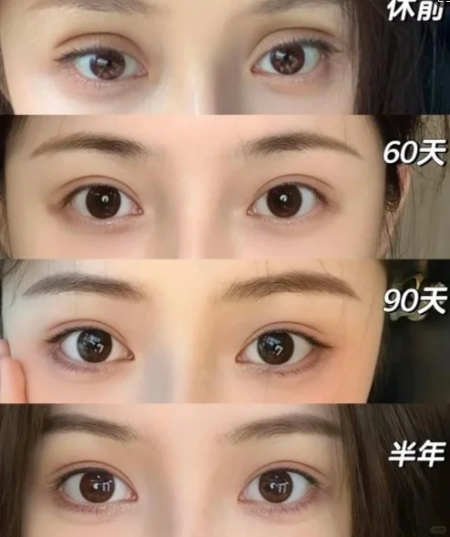 厦门双眼皮修复专家陈运生和张宏哪个医生做的好?