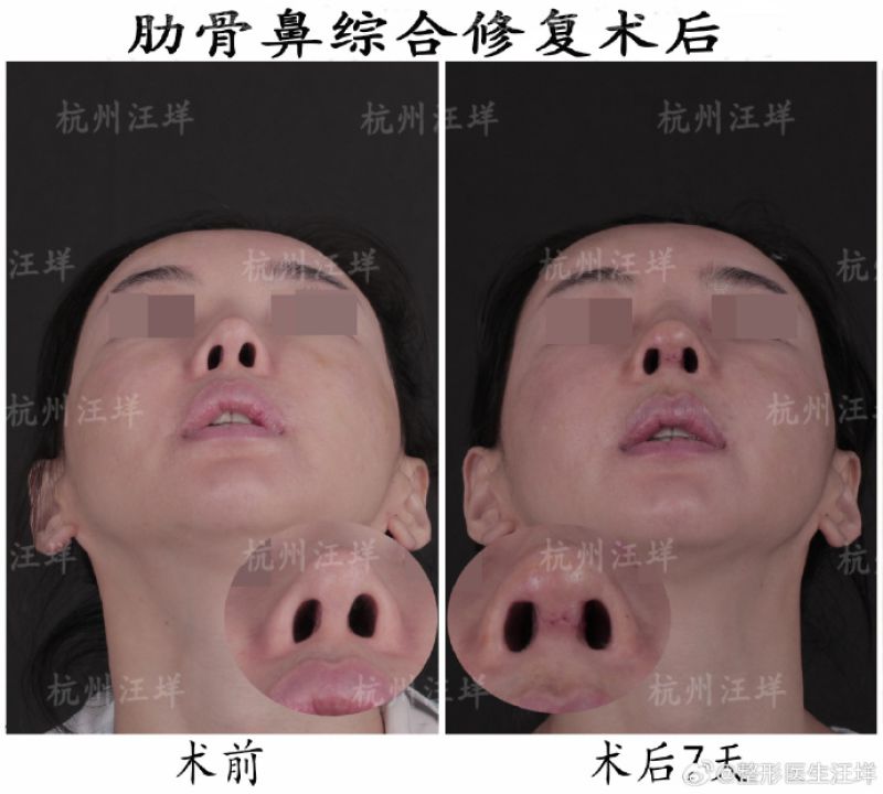 杭州隆鼻专家汪垟和李保锴哪个医生做鼻修复更好？