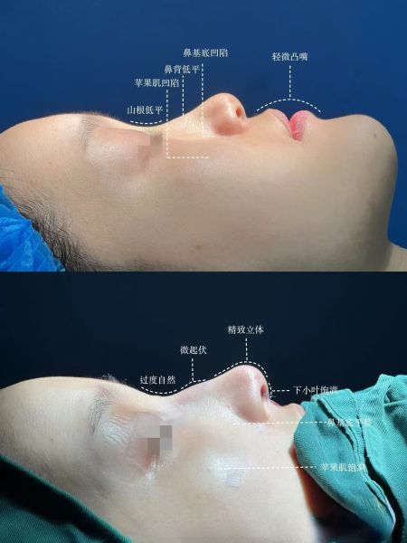 2026年上海隆鼻医生哪个医生技术好?上海隆鼻推荐哪个医生?