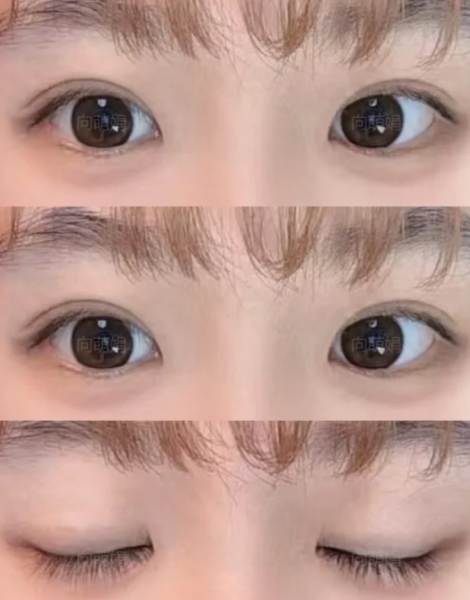 深圳双眼皮修复向萌娟和王志东哪个医生做眼修复技术好？