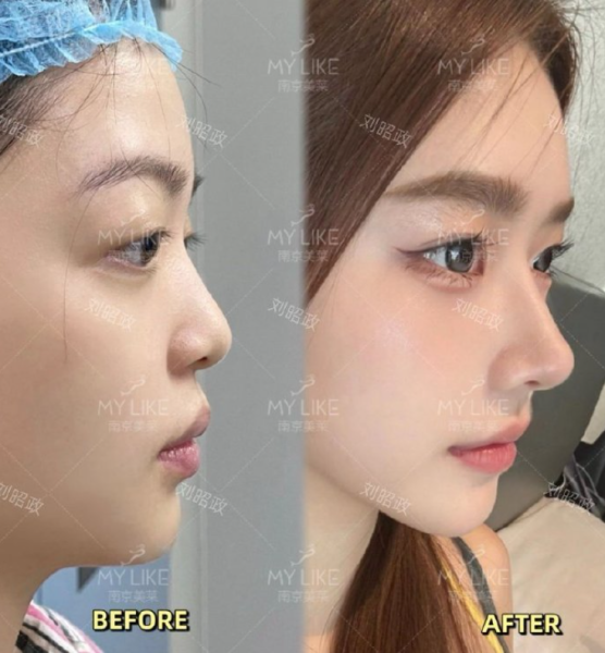 南京隆鼻修复专家刘昭政和林金德哪个鼻子修复技术好？