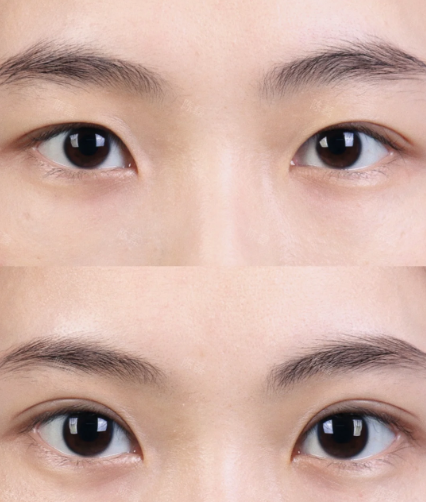 大连割双眼皮专家王洁晴和李研哪个医生做双眼皮好？