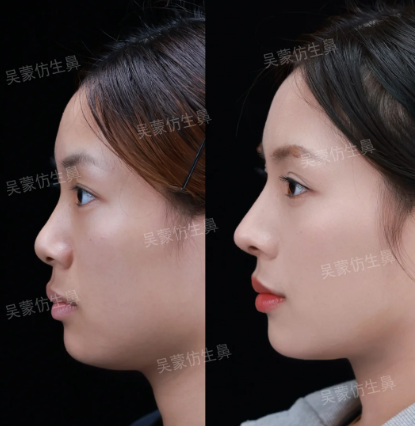 2026长沙隆鼻比较好的医生：吴蒙、王先成、熊宜文、邓颖、戴海飞谁技术最好？