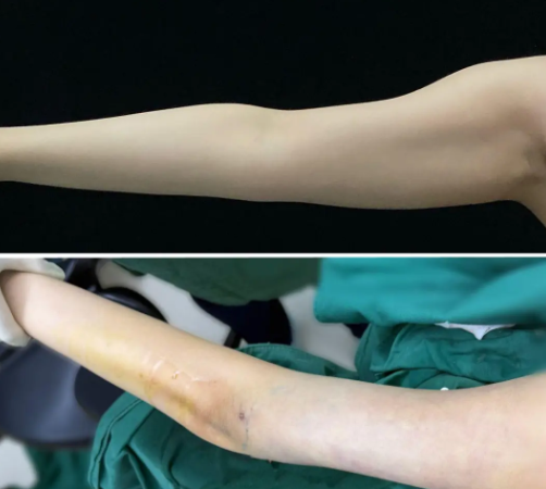 沈阳吸脂哪个医生好？冷冰、王晨超、王迪做脂肪吸脂谁技术最好？