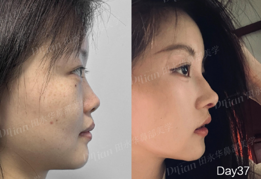 田永华隆鼻案例