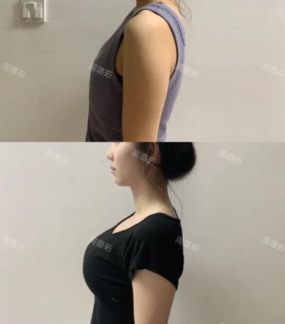 周医生丰胸案例