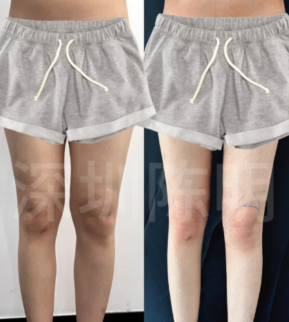 陈仕文吸脂案例