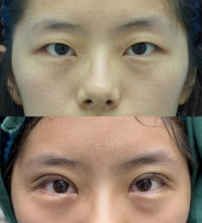 严玲玲双眼皮案例