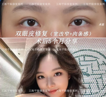 王海平双眼皮修复案例