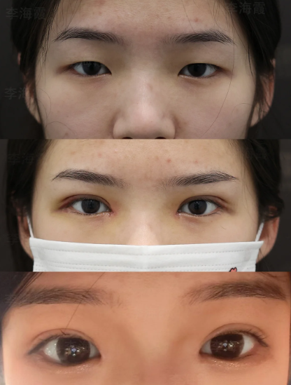 李海霞双眼皮案例