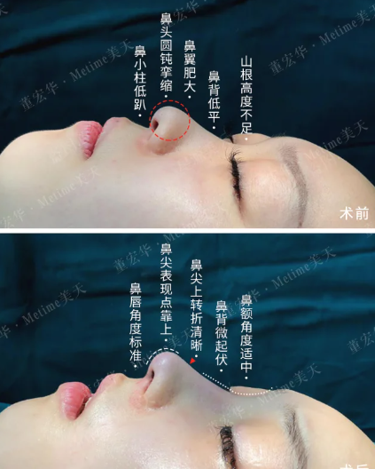 董宏华隆鼻案例