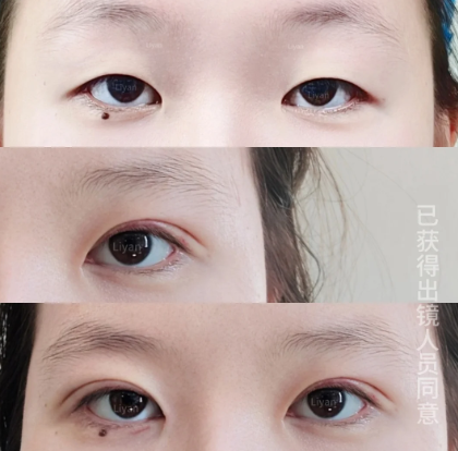 李研割双眼皮案例