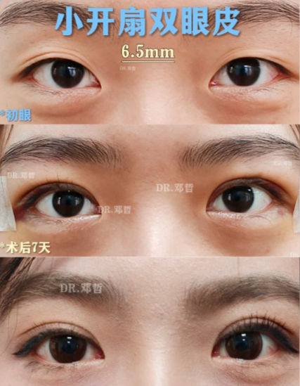 邓哲双眼皮案例