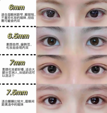 朱喆辰双眼皮案例