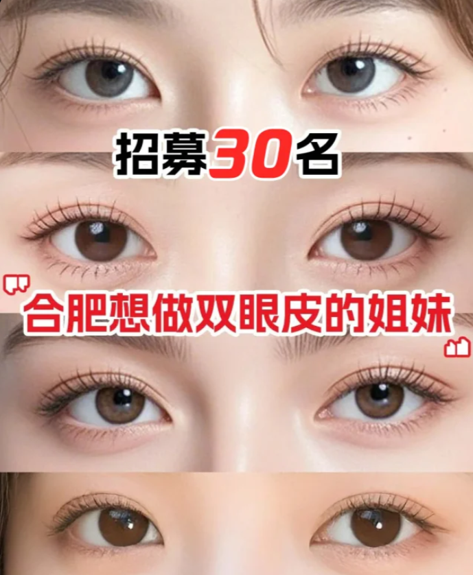 合肥双眼皮医生