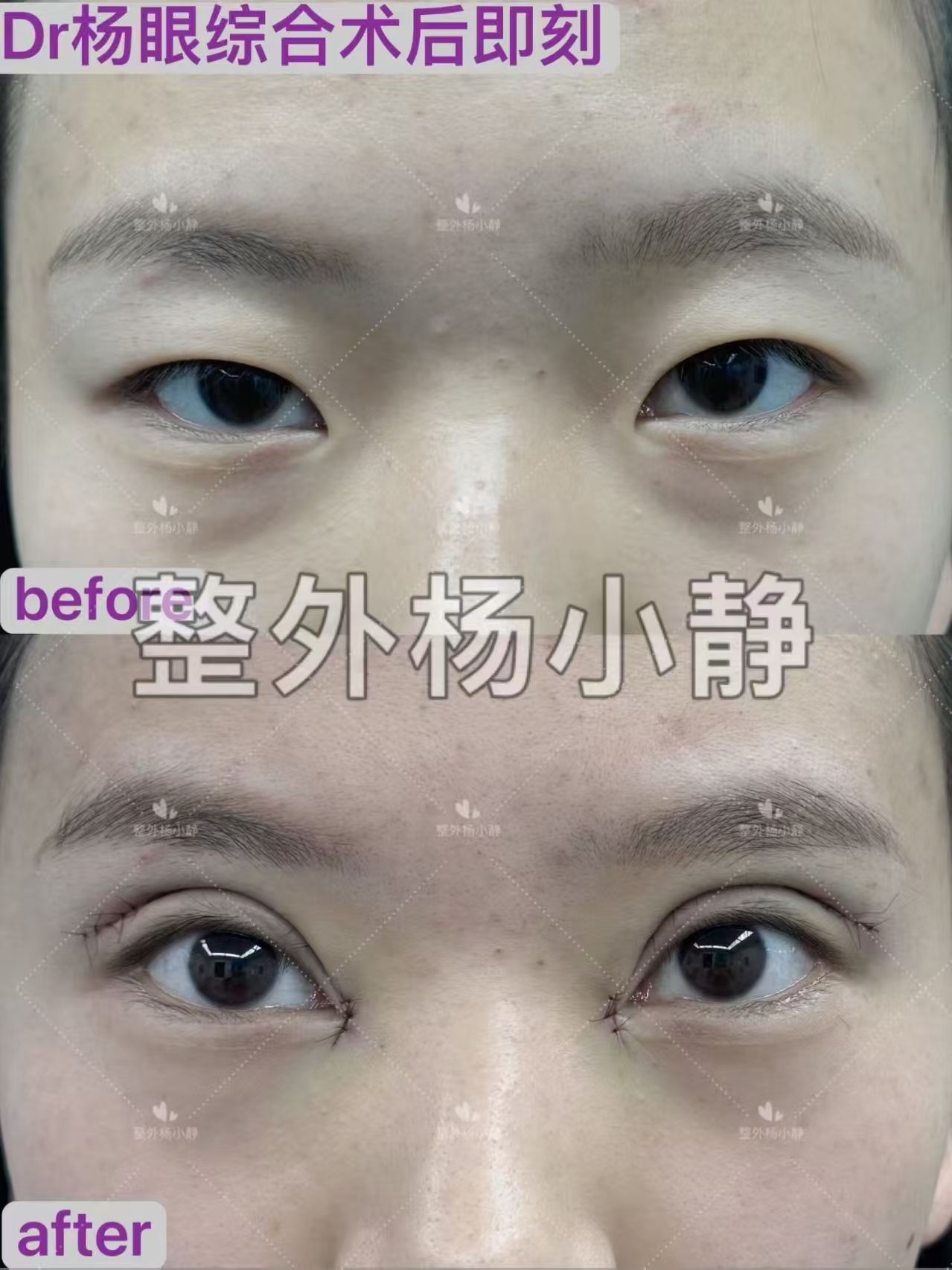 杨小静双眼皮案例