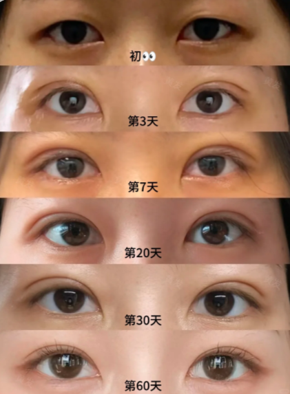 2026南京双眼皮医生哪个好？黄发、朱喆辰、王金明、刘宁做双眼皮谁厉害？