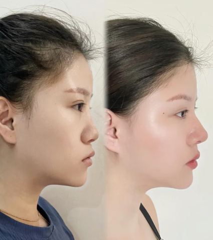 沈阳鼻整形范东良和李继森哪个医生口碑好？范东良和李继森隆鼻预约咨询