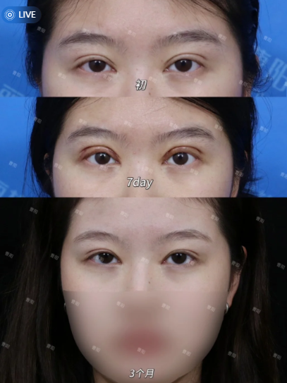 2026重庆双眼皮修复医生曹阳、刘杰、田怡这三个医生哪个最好？