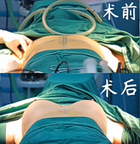 南京假体隆胸夏建军和沈干哪个医生口碑好？夏建军沈干做丰胸谁好？