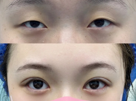 长沙双眼皮邹俊峰和罗亮哪个医生技术好？邹俊峰和罗亮预约咨询电话