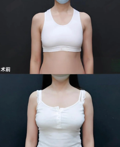 重庆假体丰胸医生哪个好？章小平和周璐珩哪个好？