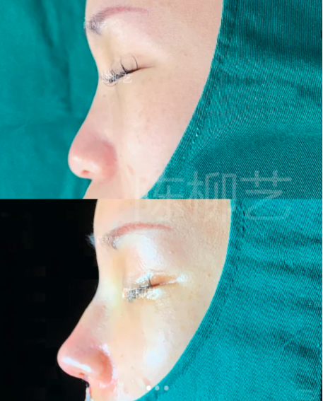 苏州隆鼻专家陈柳艺和张亮哪个医生做鼻子口碑好？