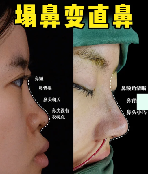 合肥隆鼻医生赵士俊和孙洋哪个技术好？赵士俊孙洋做鼻子谁好？