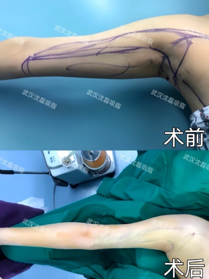 武汉吸脂哪个医生技术最好？朱继锋、陈克、沈磊、包涛、杨杰吸脂技术怎么样？