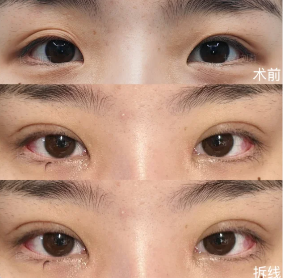 长春割双眼皮专家刘莉和宋斌哪个医生口碑好？