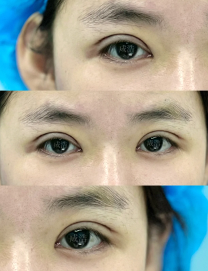 台州成浩和郑金满哪个医生割双眼皮好？成浩和郑金满做双眼皮口碑谁好？