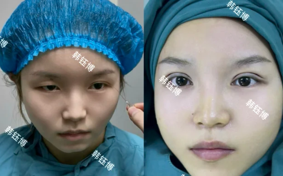 2026年西安双眼皮韩钰博、孙峰和傅先军哪个医生做的好？