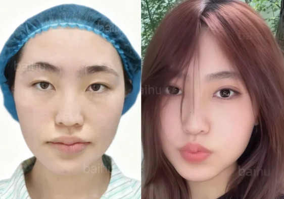 呼和浩特双眼皮医生推荐哪个？白虎和裴大伟割双眼皮谁好？