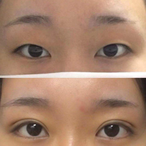 大连做双眼皮专家赵穆欣和李研哪个医生割双眼皮口碑好？