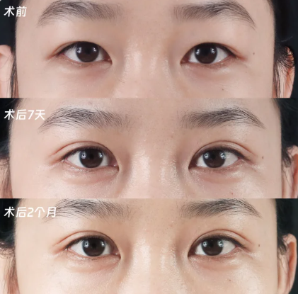 李晓冬割双眼皮案例