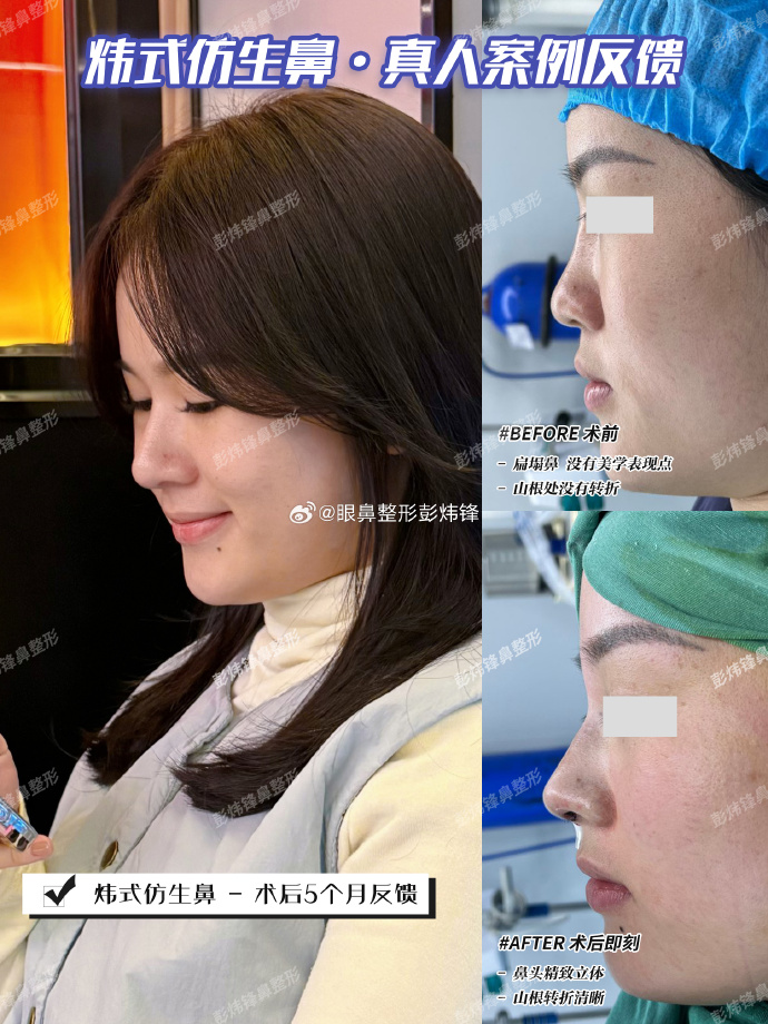 彭医生隆鼻案例