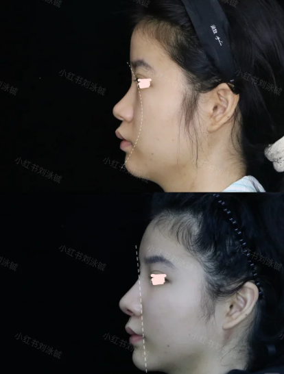 刘泳铖隆鼻案例