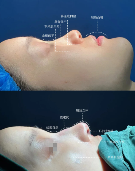 张旭龙隆鼻案例