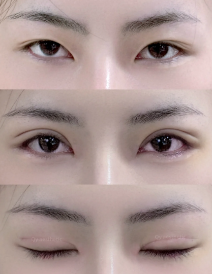 李名富割双眼皮案例