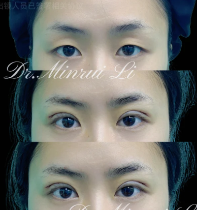 李敏锐割双眼皮案例