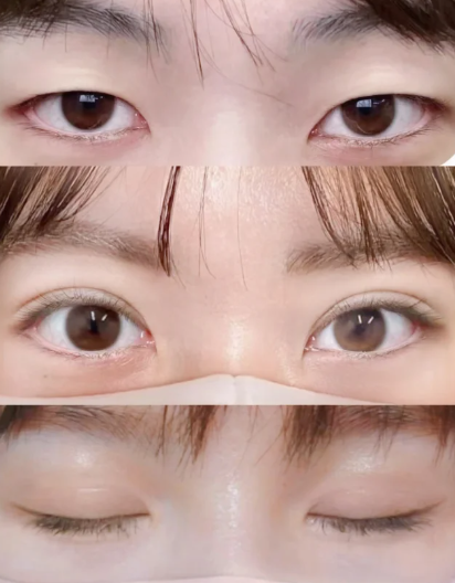 宗宪磊双眼皮案例