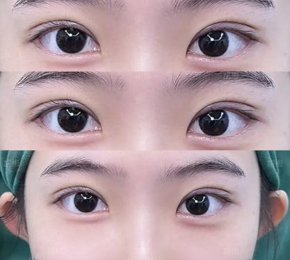 胡彬割双眼皮案例